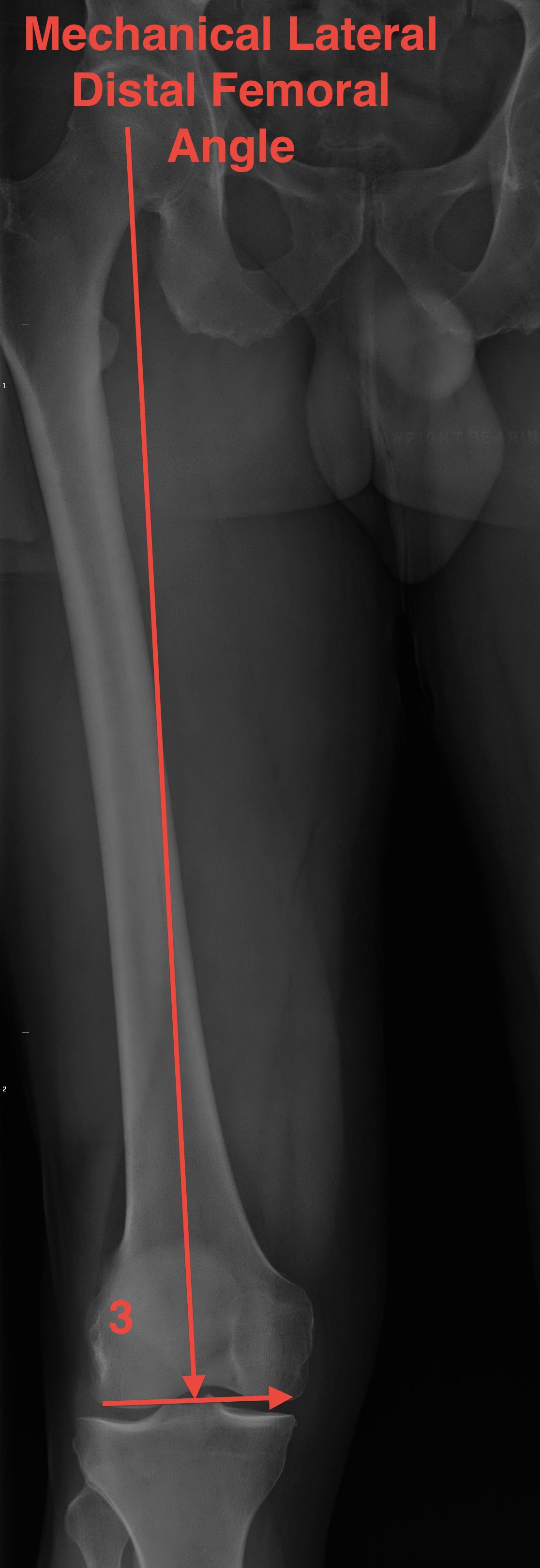 Mechanical Lateral Distal Femoral Angle